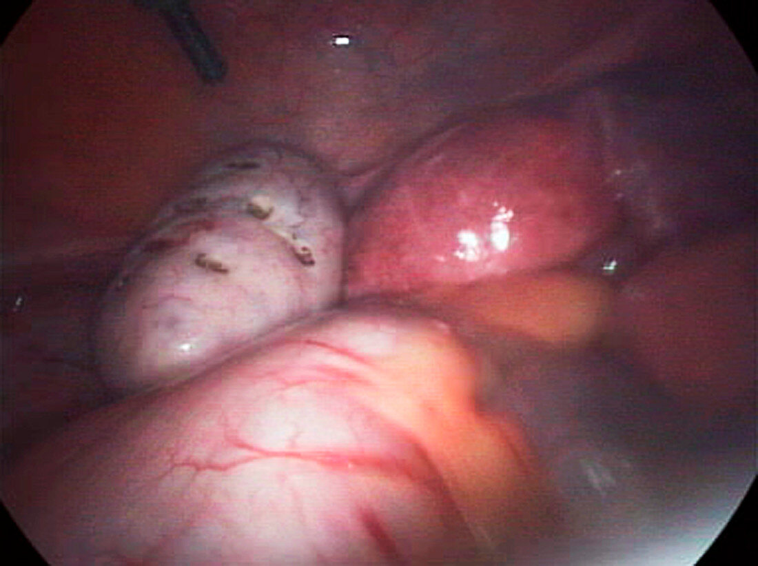 Polycystic ovary syndrome treatment