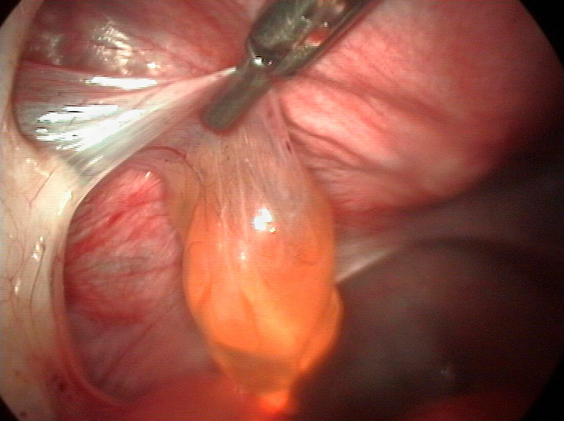 Fallopian tube cyst