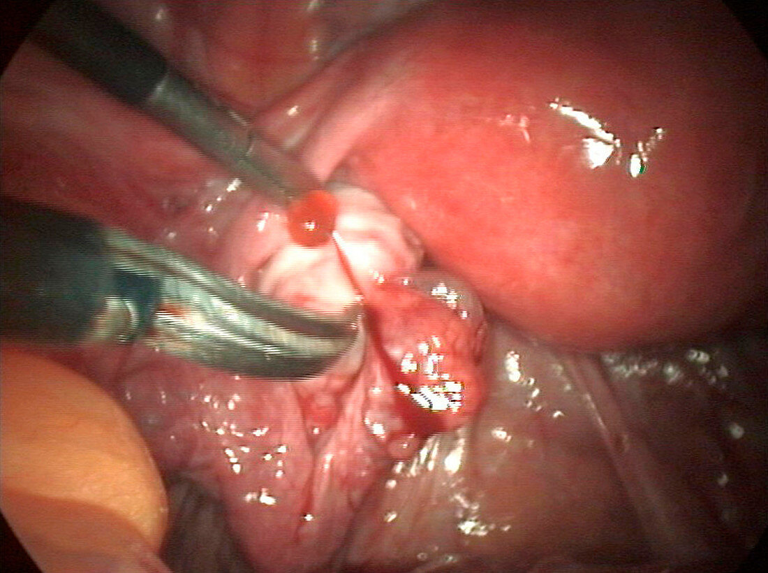 Removal of fallopian tube cyst