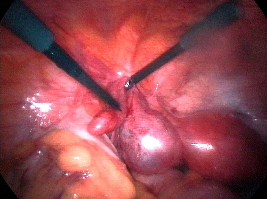 Swollen fallopian tube