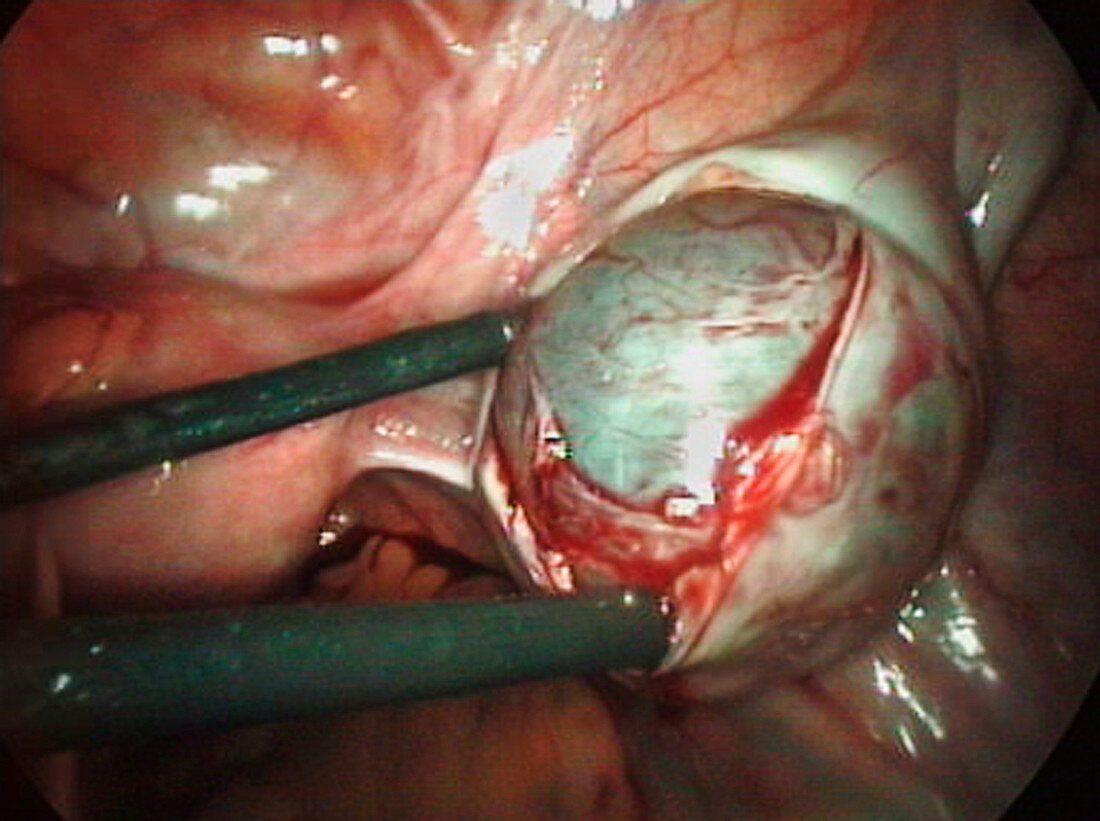 Removal of an ovarian cyst (2 of 4)