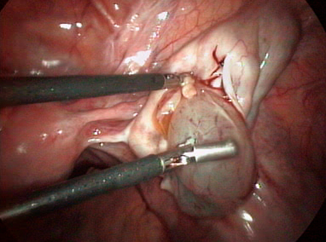 Removal of an ovarian cyst (4 of 4)