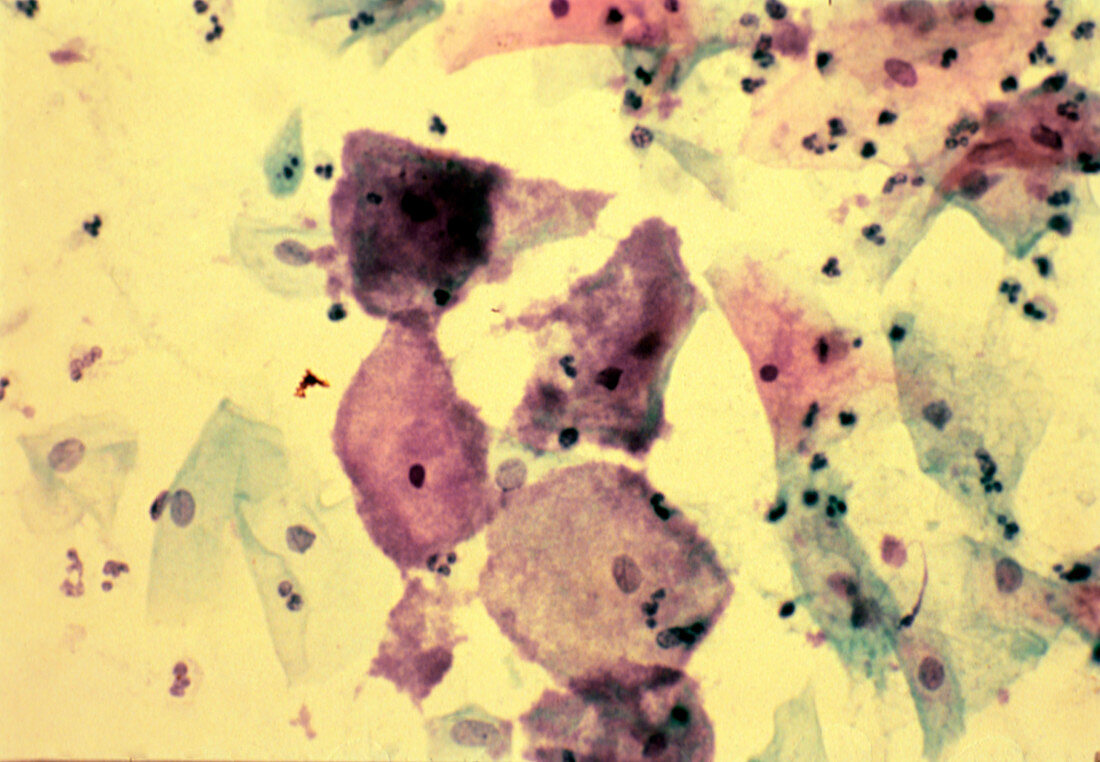 LM of vaginal smear showing bacterial infection