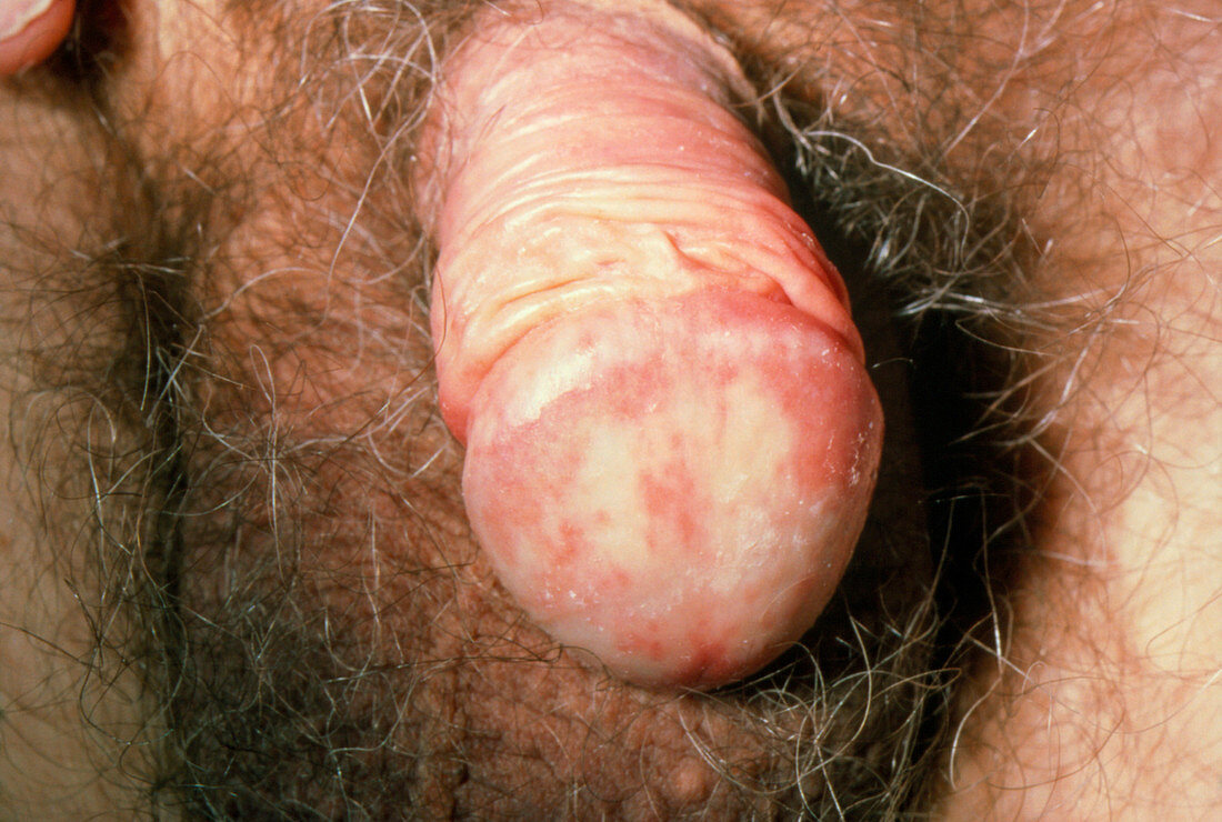 Candidal balanitis: thrush infection of penis