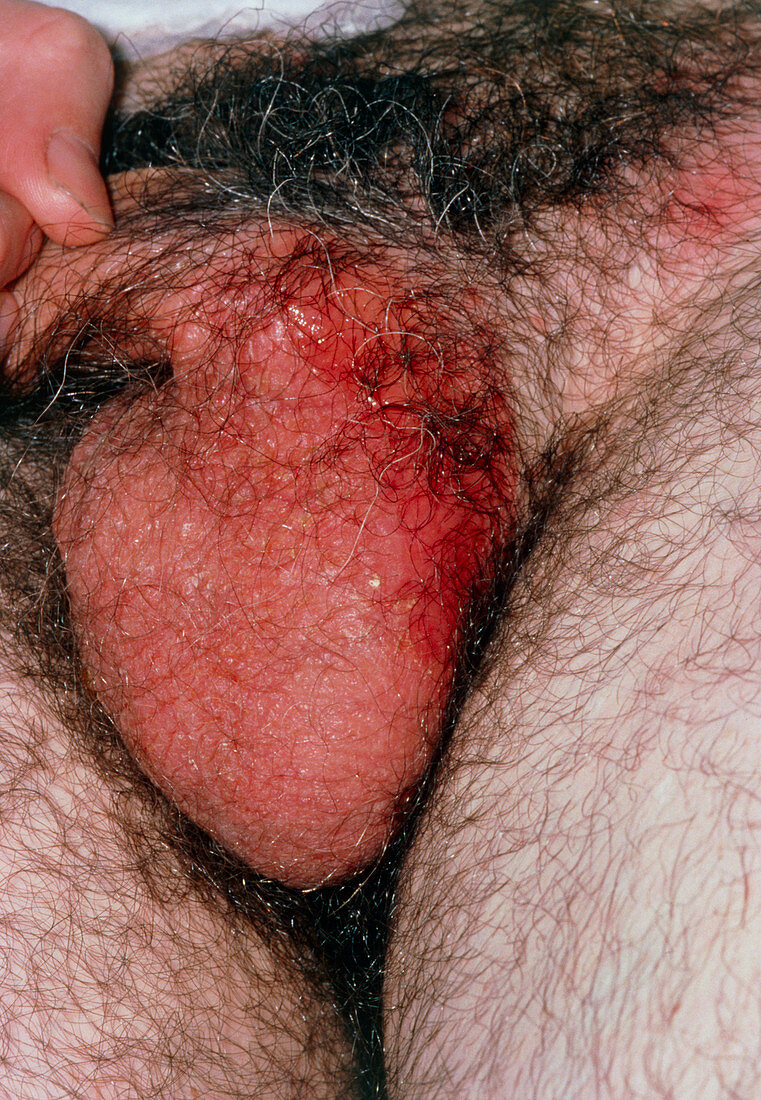 Patient's scrotum affected by genital herpes