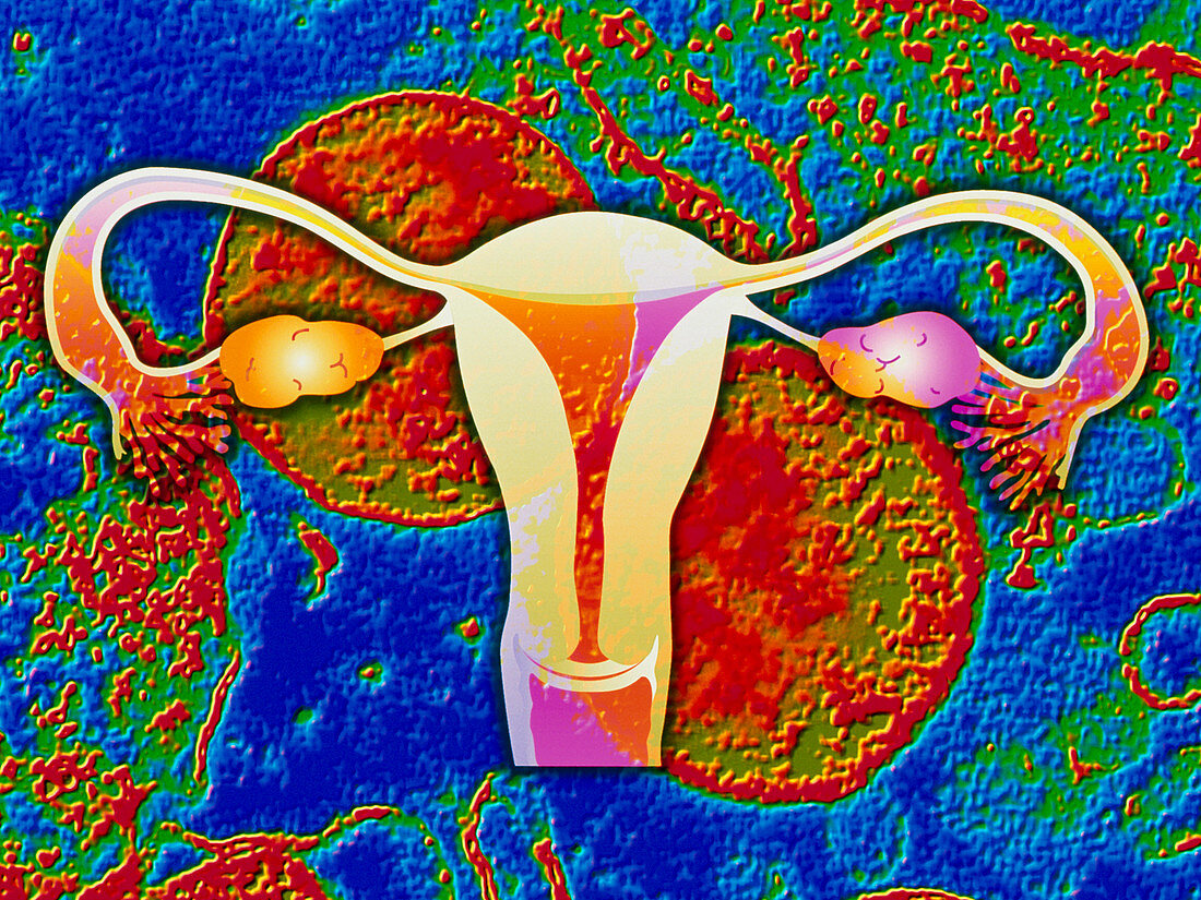 Chlamydia infection: bacteria & artwork of uterus