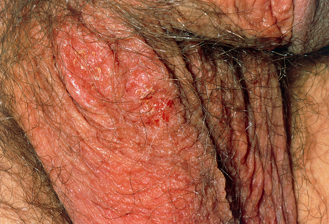 Genital sores on scrotum of patient with herpes