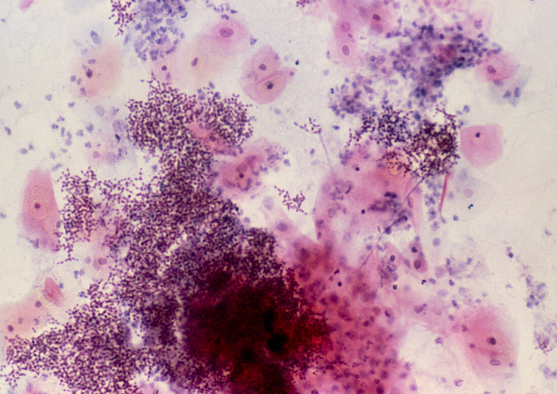 LM of cervical smear with thrush infection