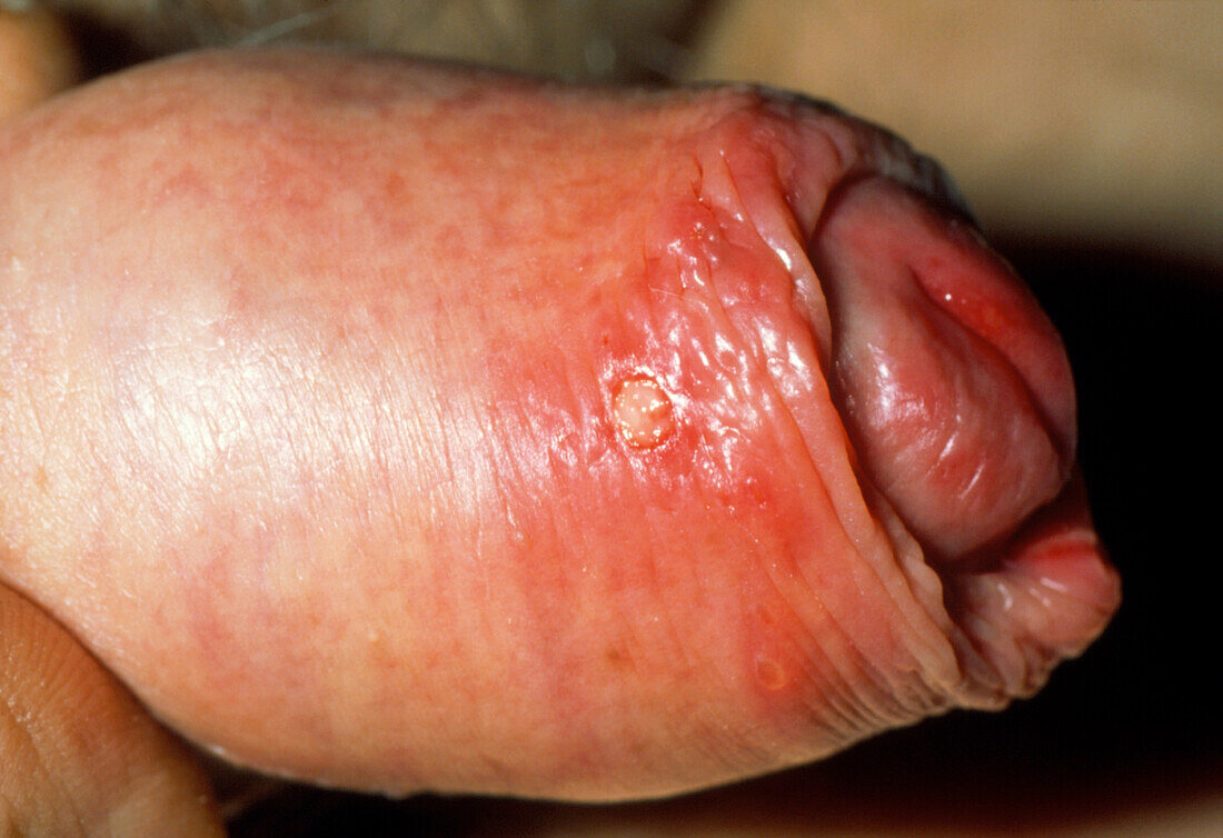 Close-up of a penis affected by herpes simplex