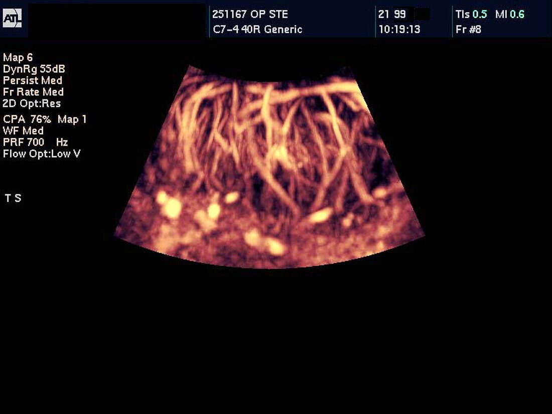 Inflamed testis,Doppler ultrasound