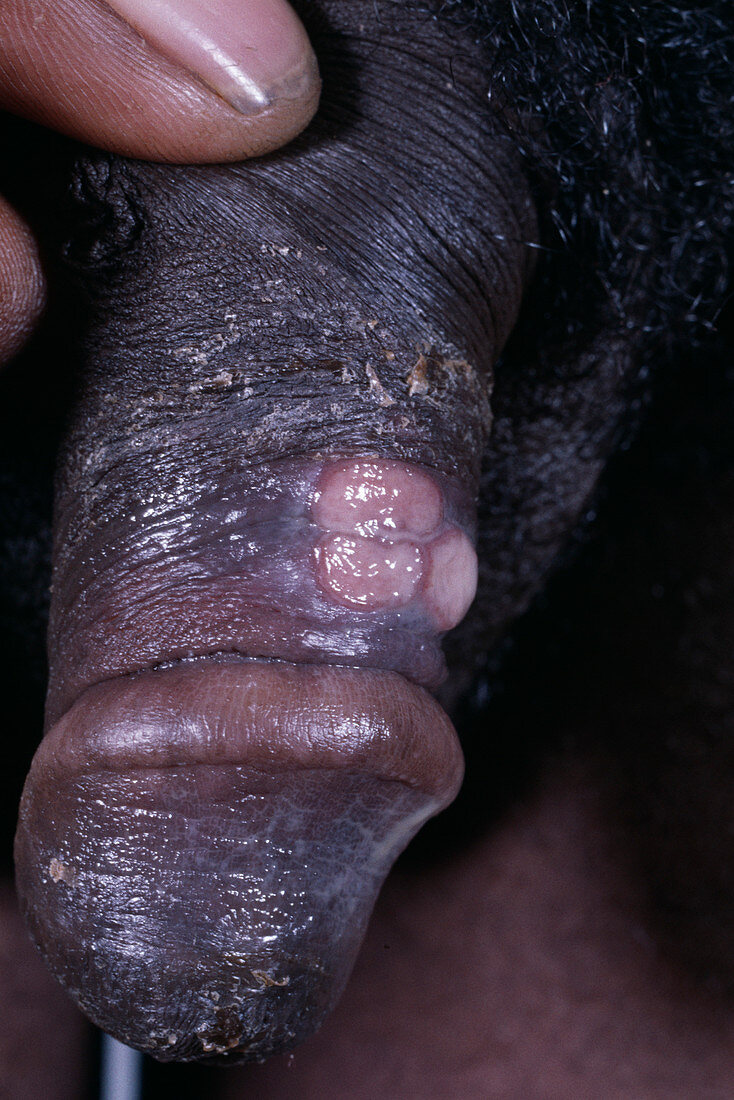 Genital chancroid ulcers