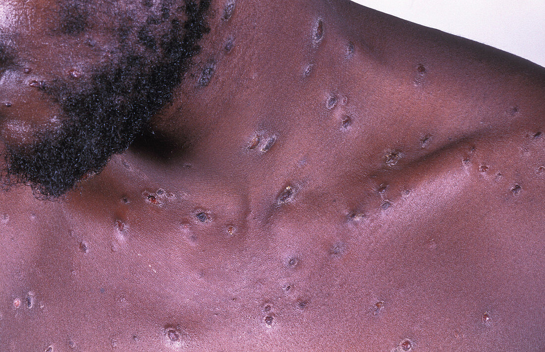 Syphilis skin lesions