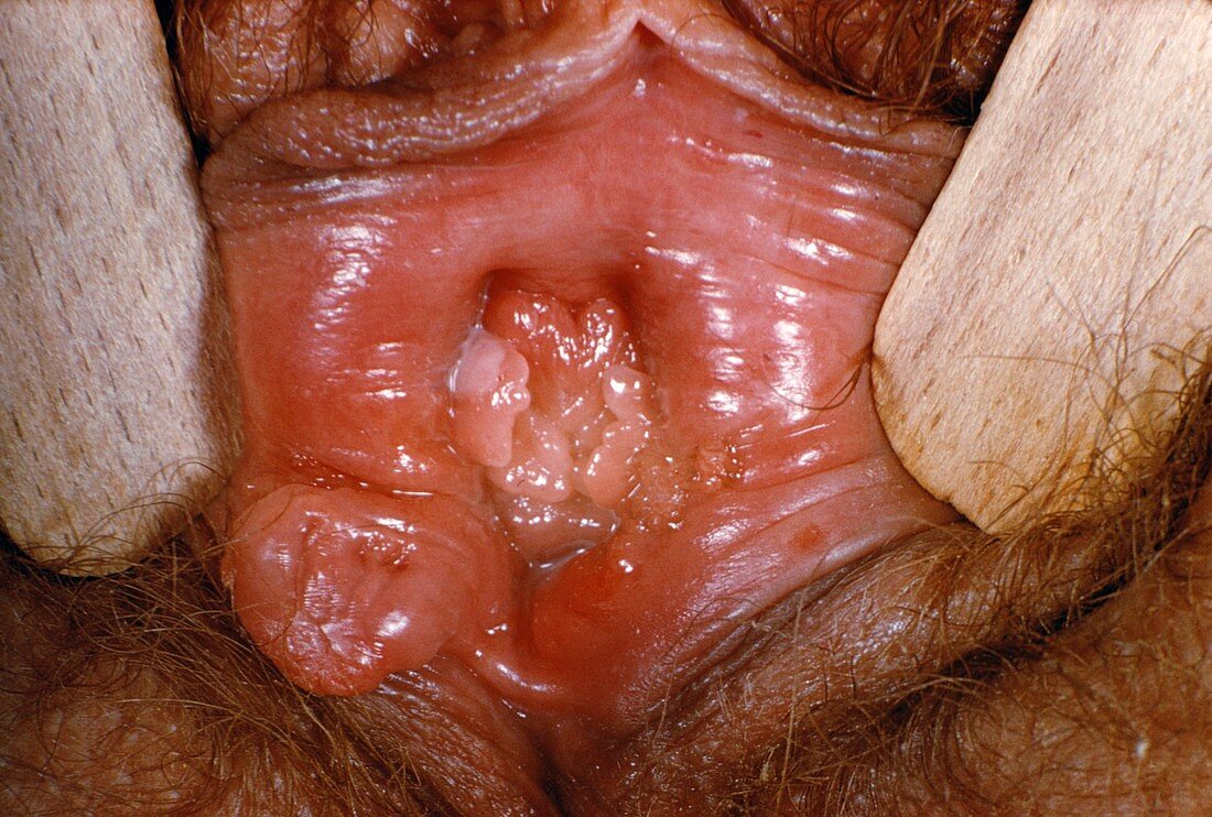 Syphilis ulcer on vulva