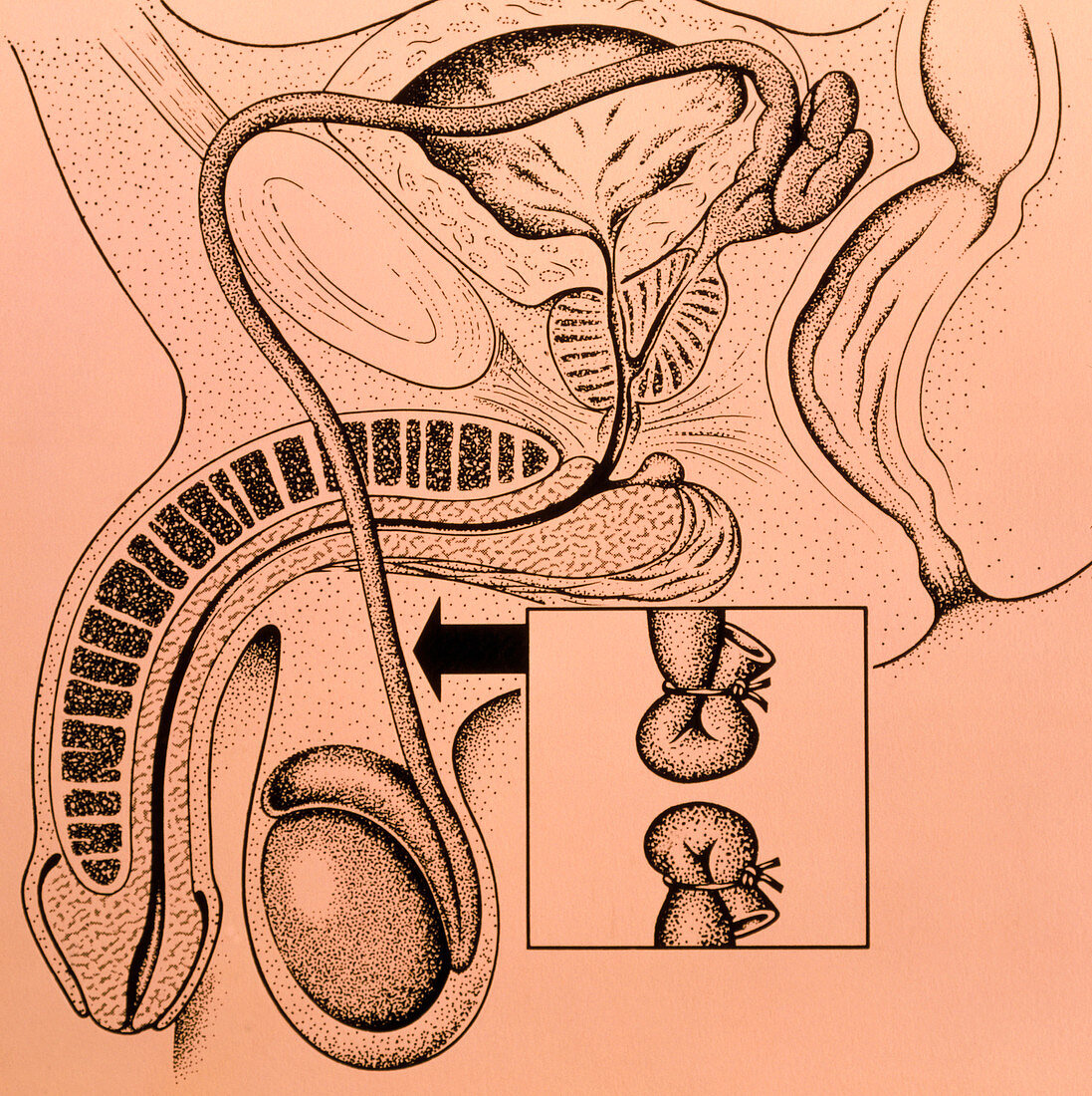 Artwork showing a vasectomy operation