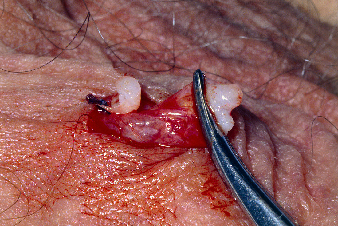 Clamping vas deferens during a vasectomy operation