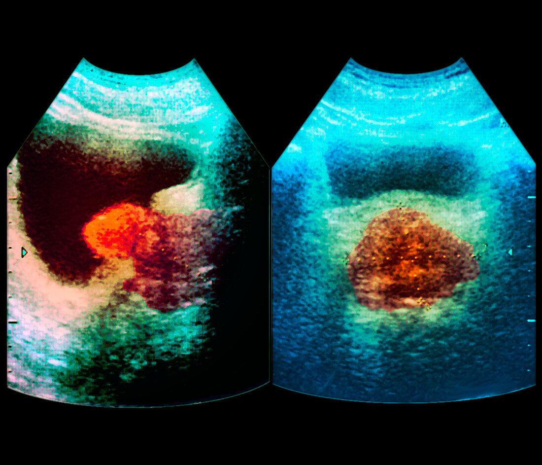 Enlarged prostate,ultrasound scan