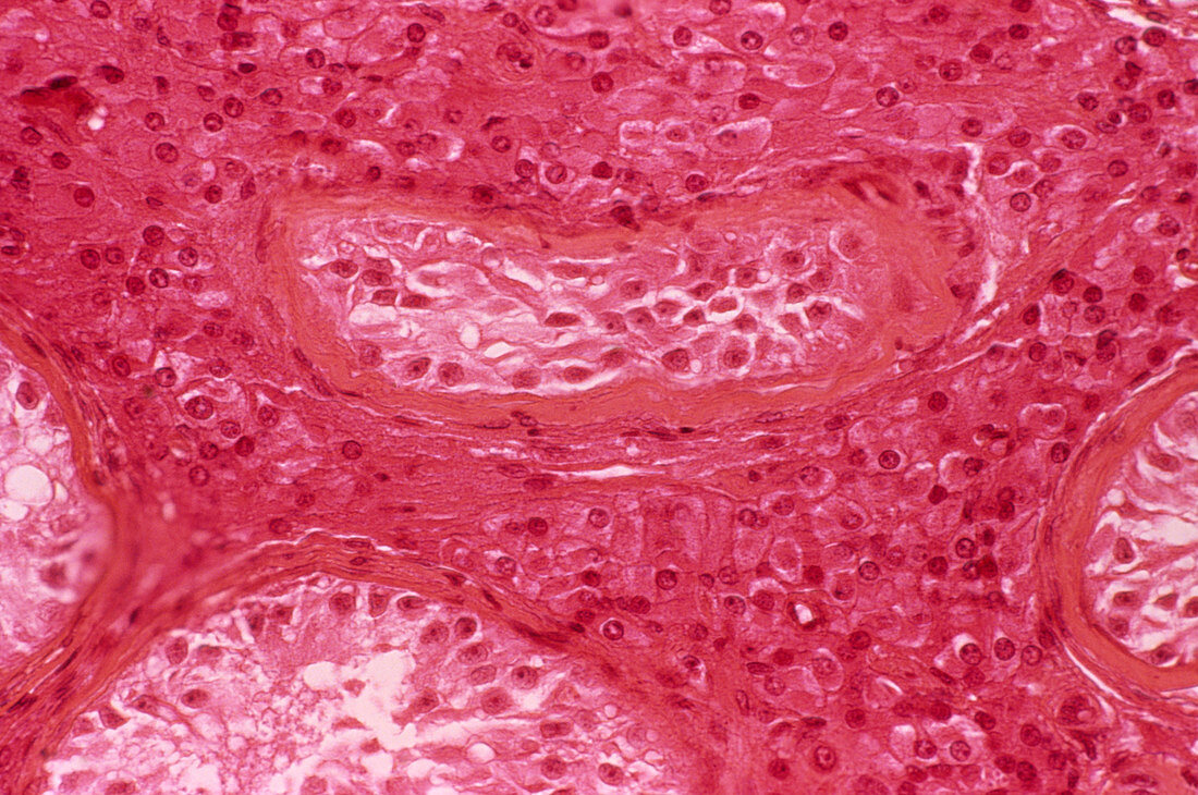 Benign testicular lump,light micrograph
