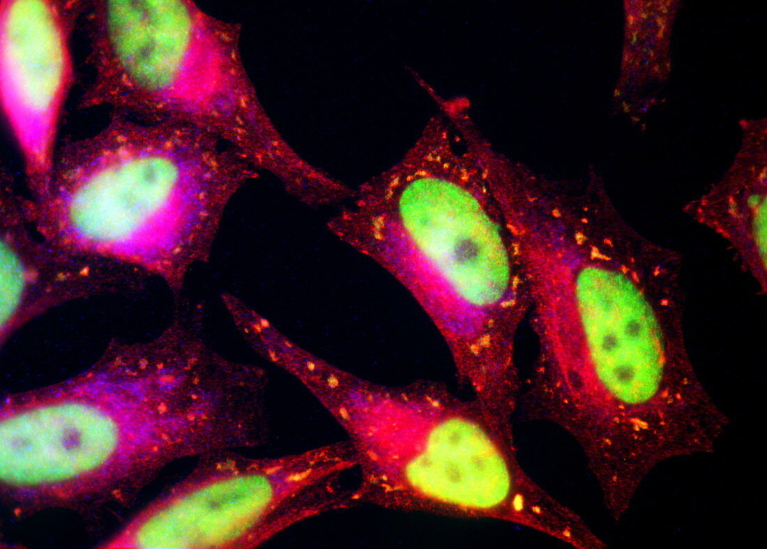 Prostate cancer cells