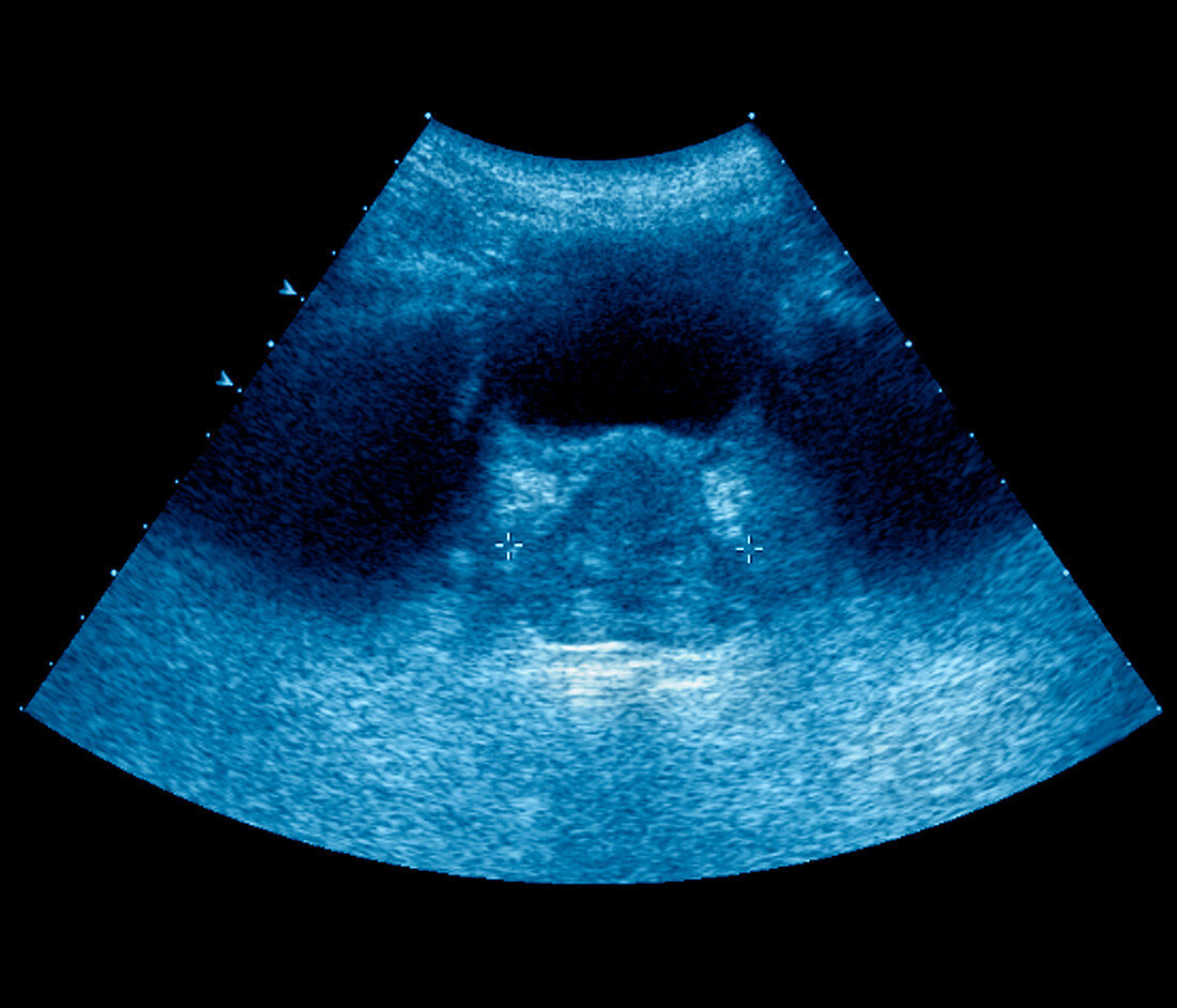 Prostate tumour,ultrasound scan