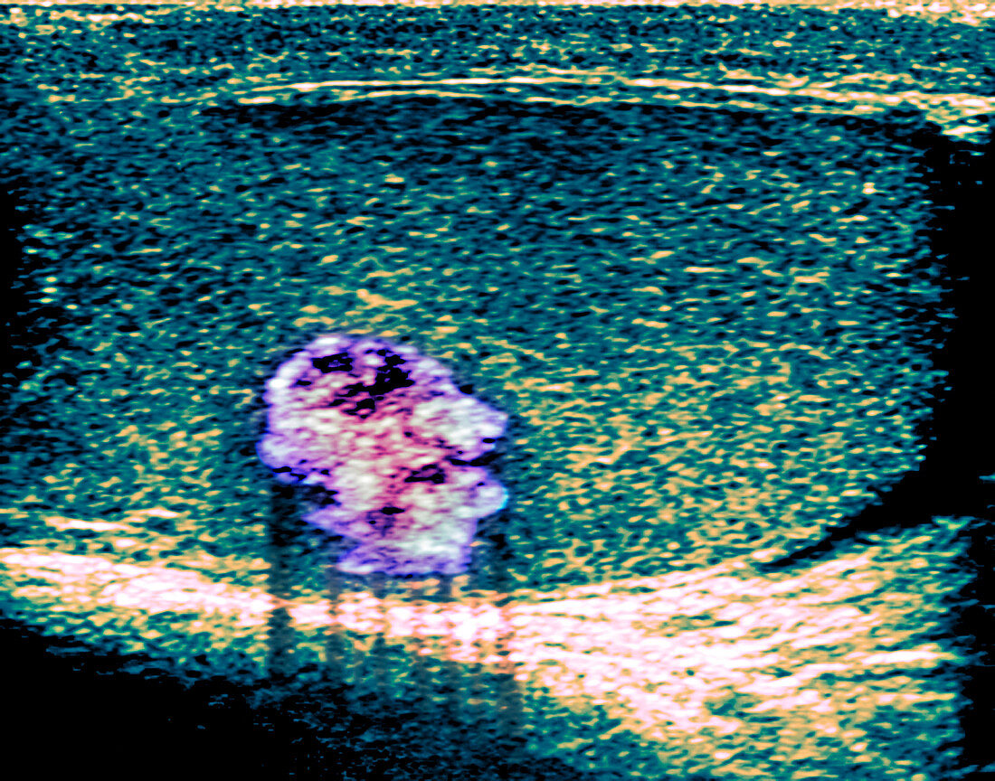 Testicular cancer,ultrasound scan