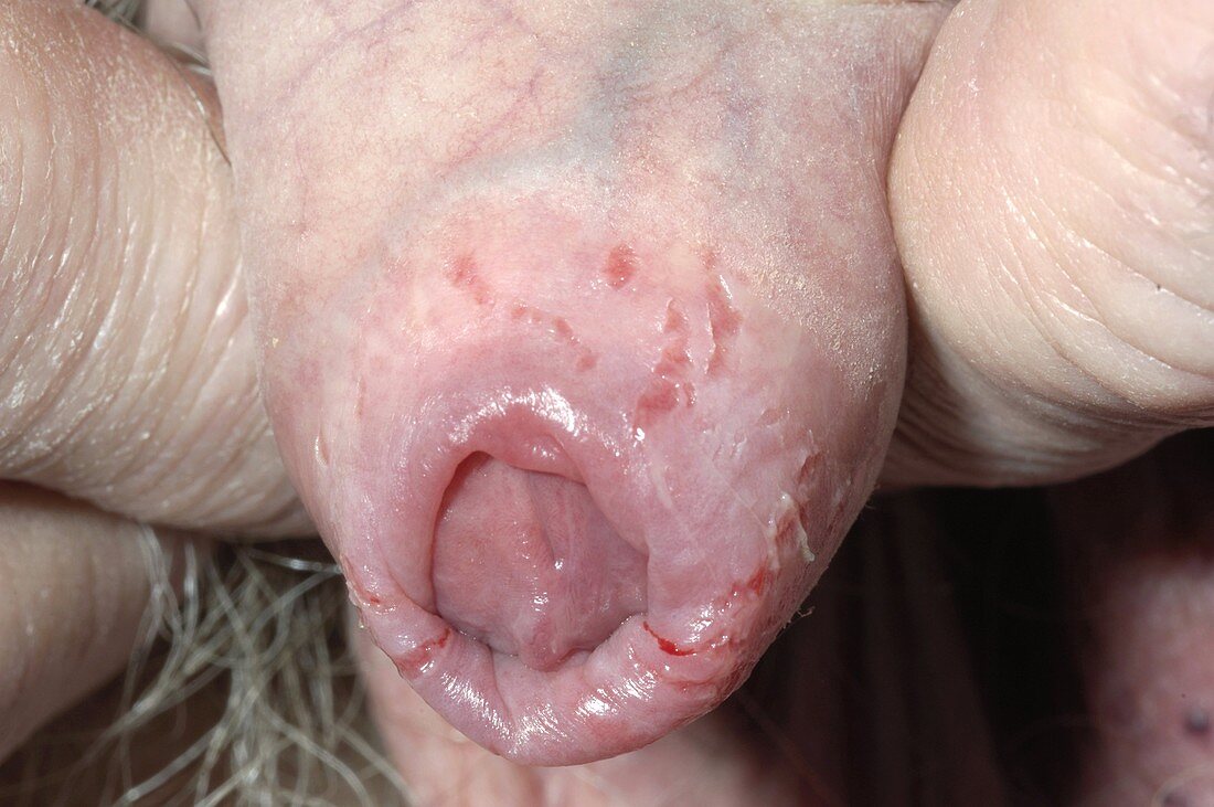 Split foreskin in fungal infection