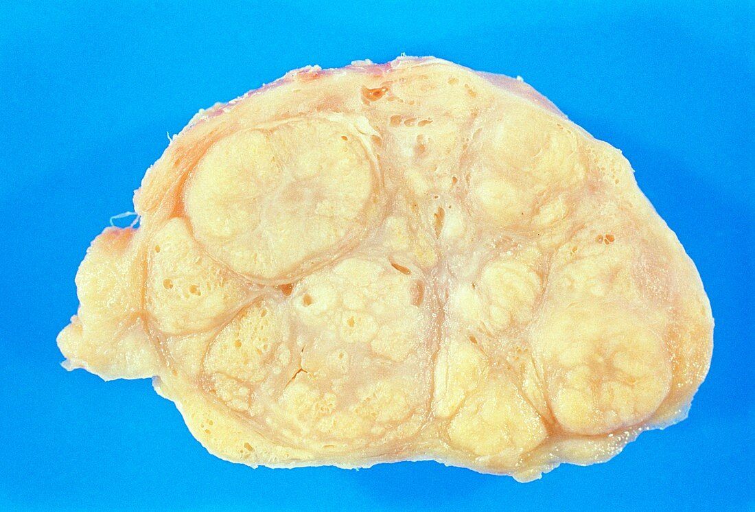 Cut prostate with benign nodular hyperplasia