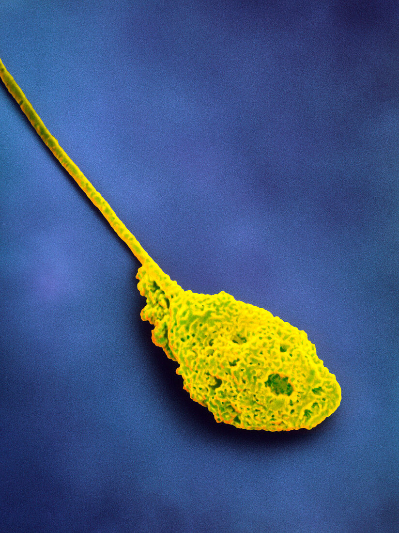 Coloured SEM of a deformed macrocephalic sperm