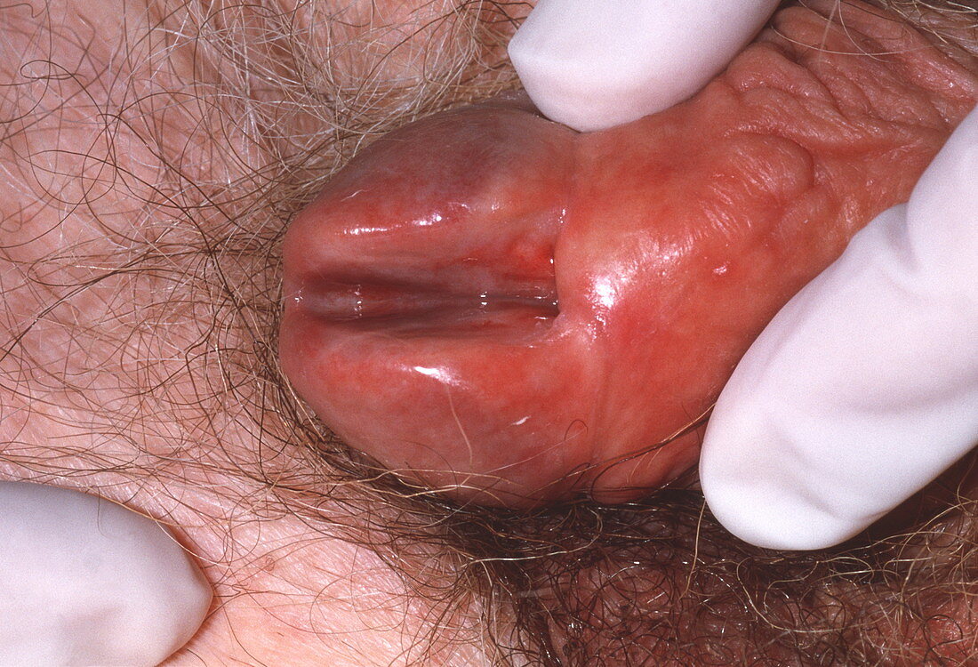Urethral filleting