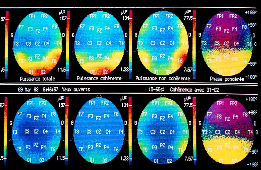 Normal EEG alpha waves: series of 8 sections
