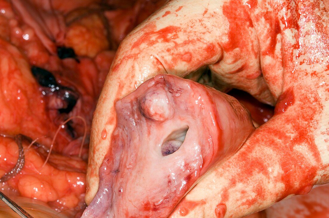 Uterus growth,post-mortem