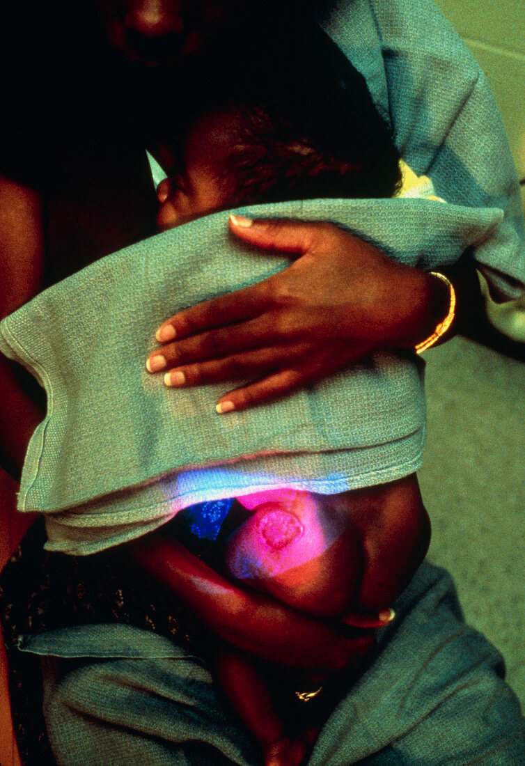 Lasers being used to treat an ulcerated birthmark