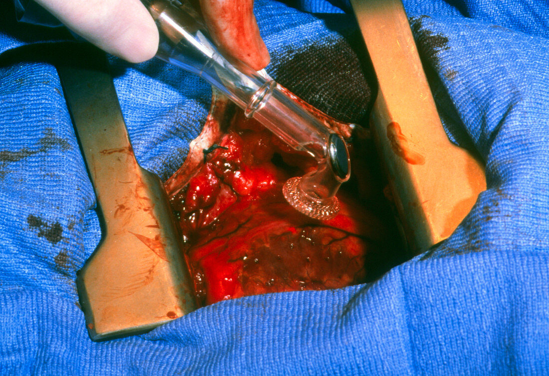 Surgeon using a laser during heart surgery