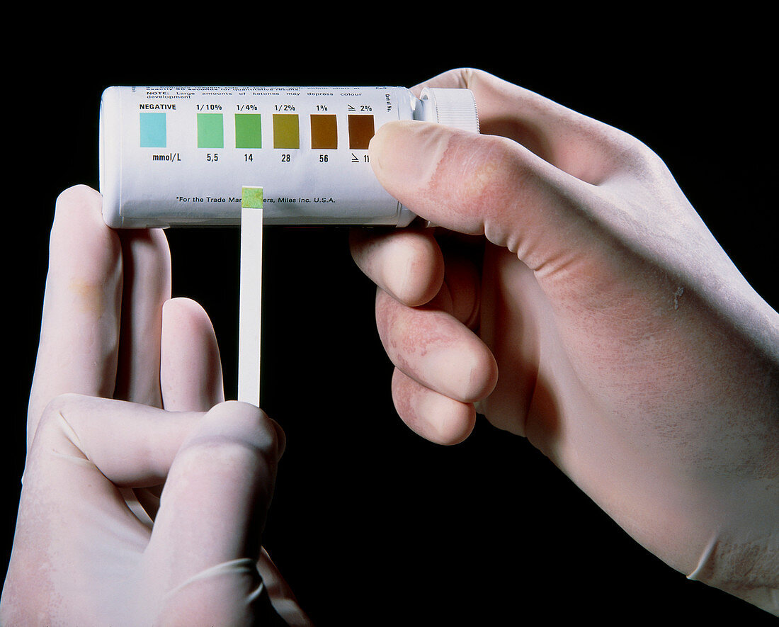 Diastix urine-test for glucose,done by GP doctor