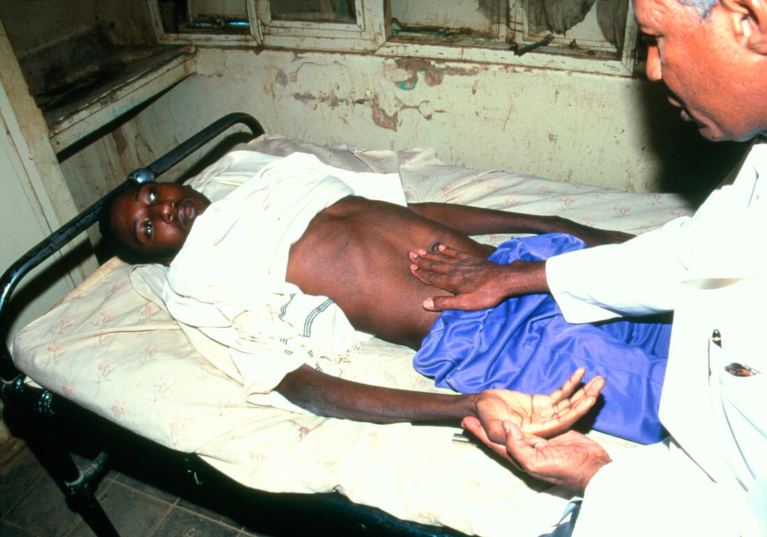 Doctor examining a visceral leishmaniasis patient