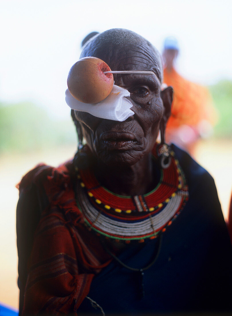 Eye surgery patient,Kenya