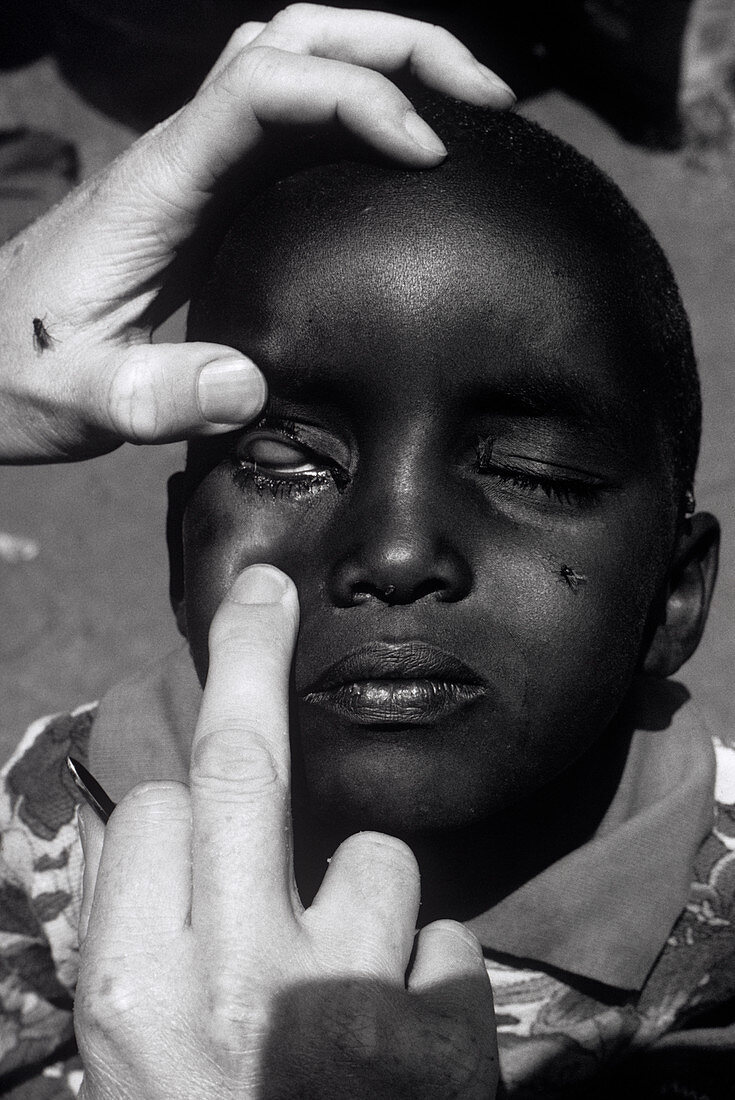 Trachoma eye infection treatment