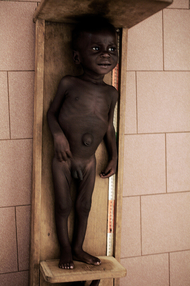 Malnourished child being assessed