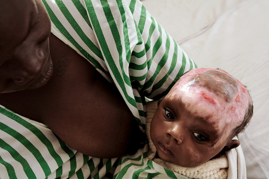 Baby with severe burns