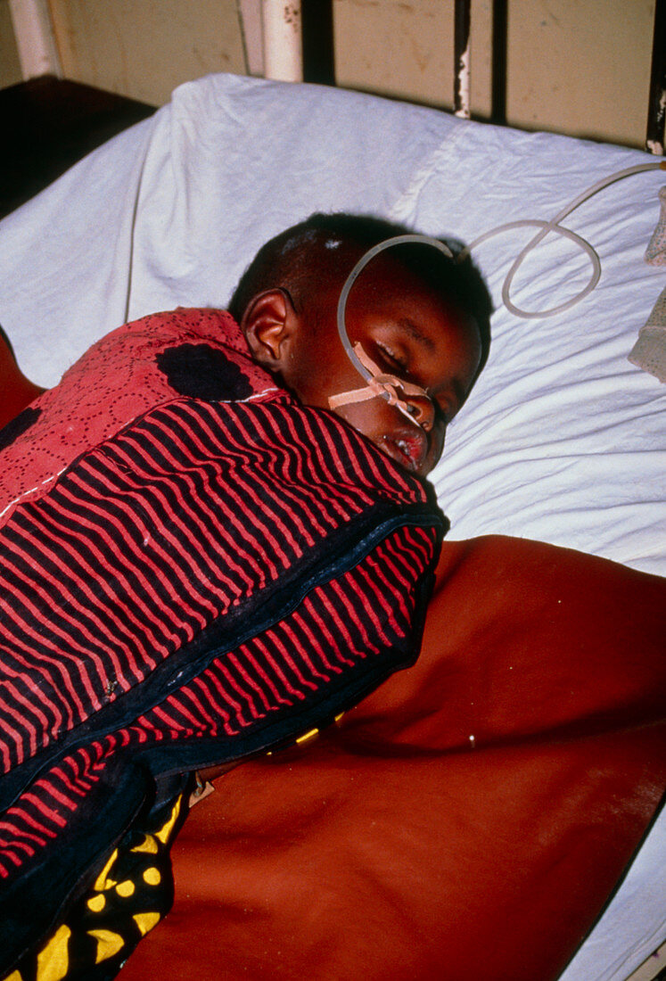 Child with severe malaria in Tanzanian hospital