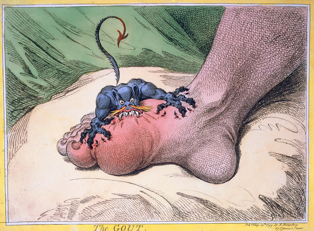 Gilray cartoon illustrating gout in the foot