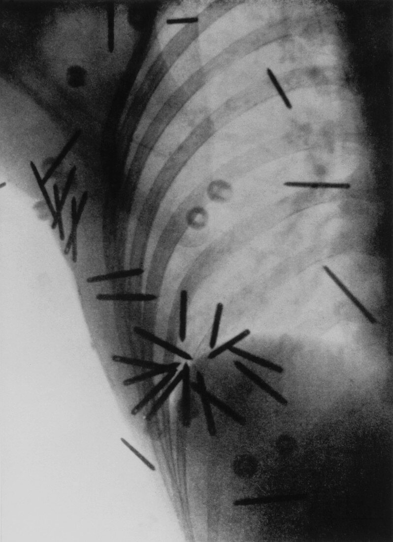 X-ray of radium needles in breast cancer treatment