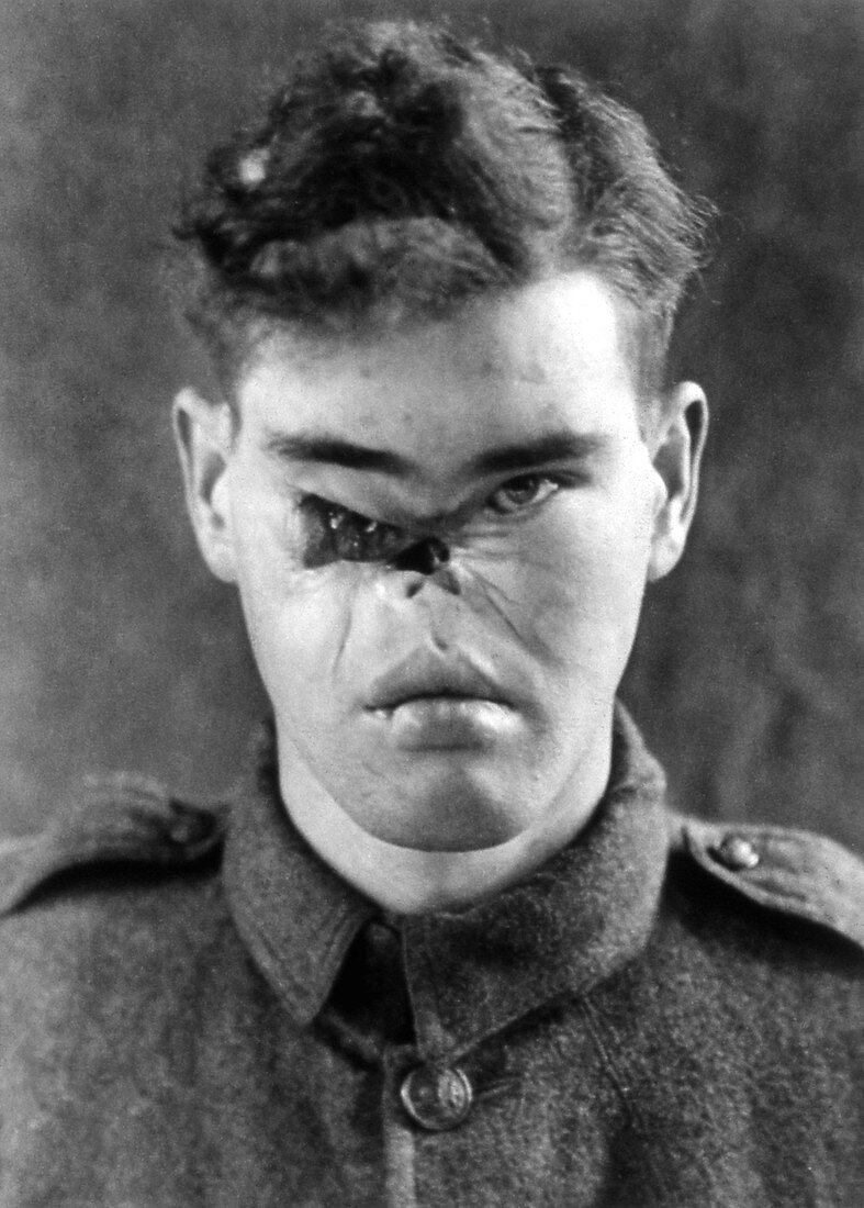 Facial wound on a World War I soldier