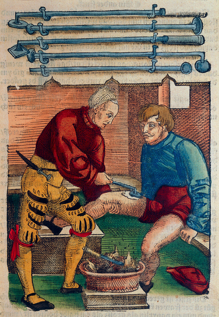 Cauterization of thigh wound 16th C