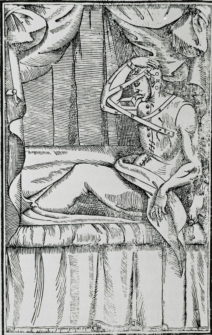 Gaspare Tagliacozzi's 16th century plastic surgery