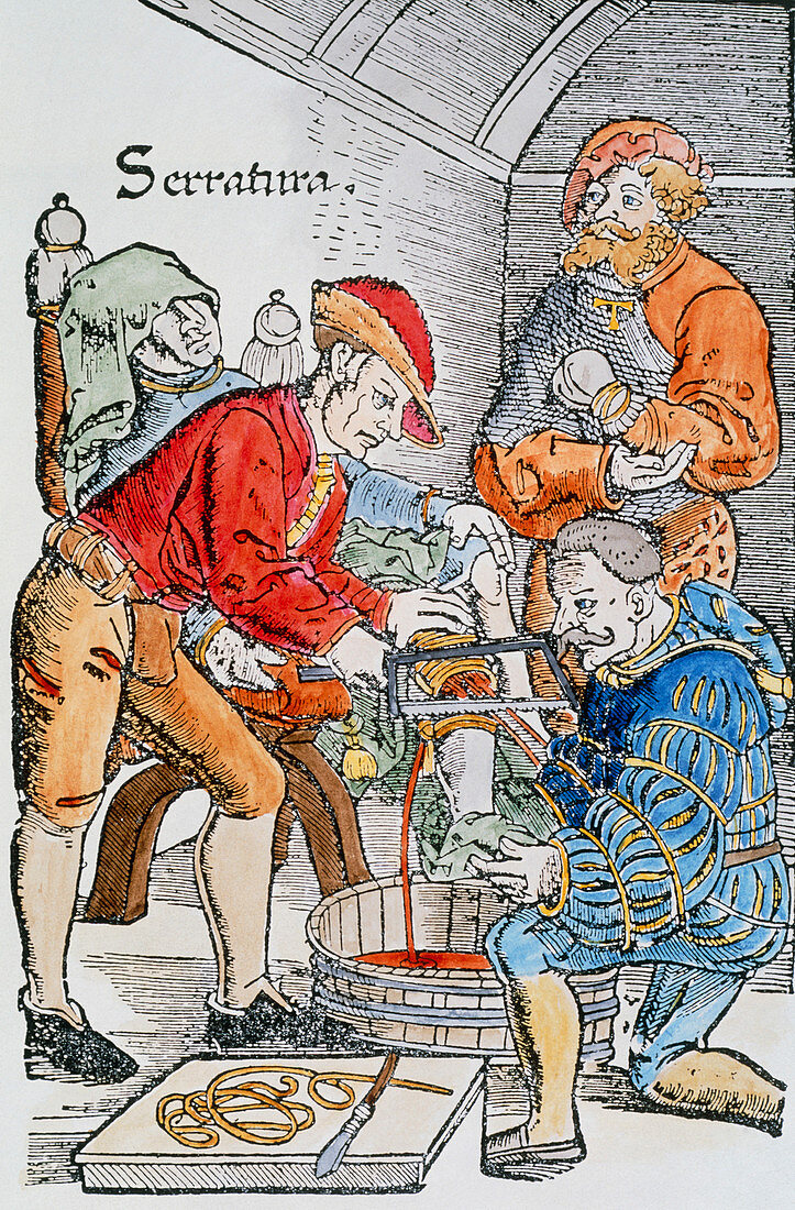 Artwork of a 16th century leg amputation