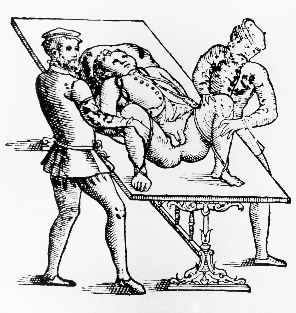Historical artwork of a lithotomy patient