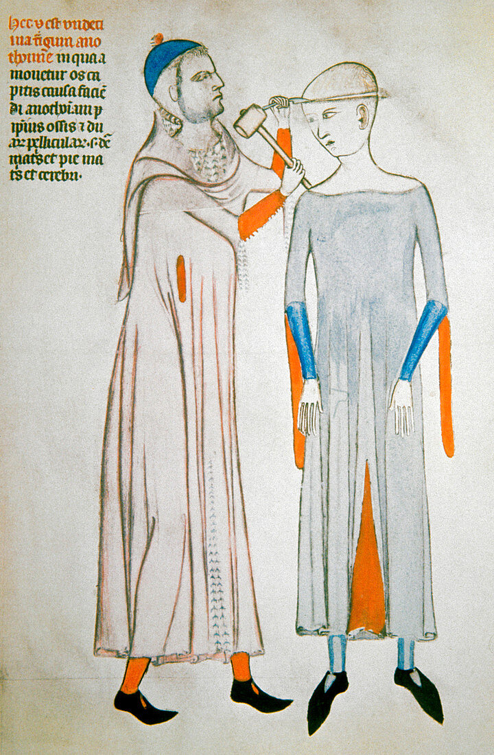 Trepanation,14th century artwork