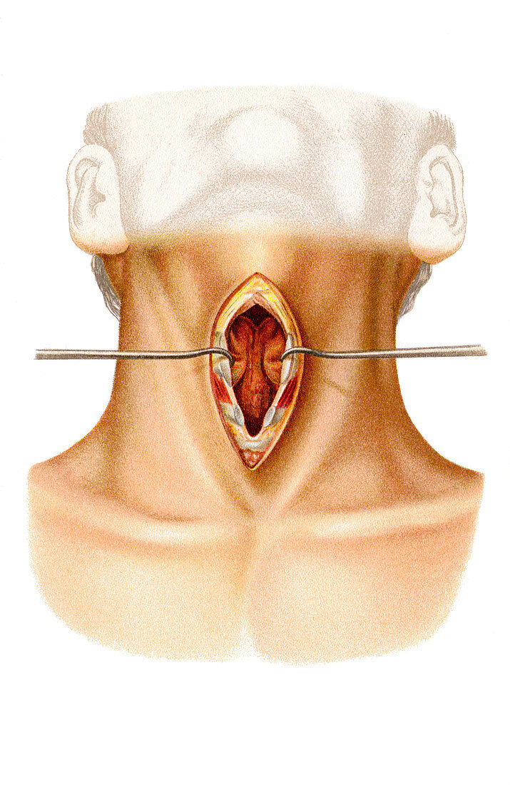 Larynx surgery,artwork