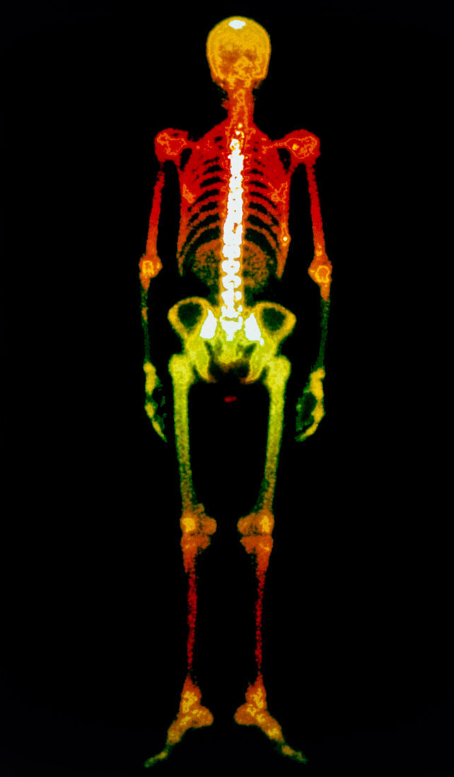 Coloured gamma scan of the human skeleton