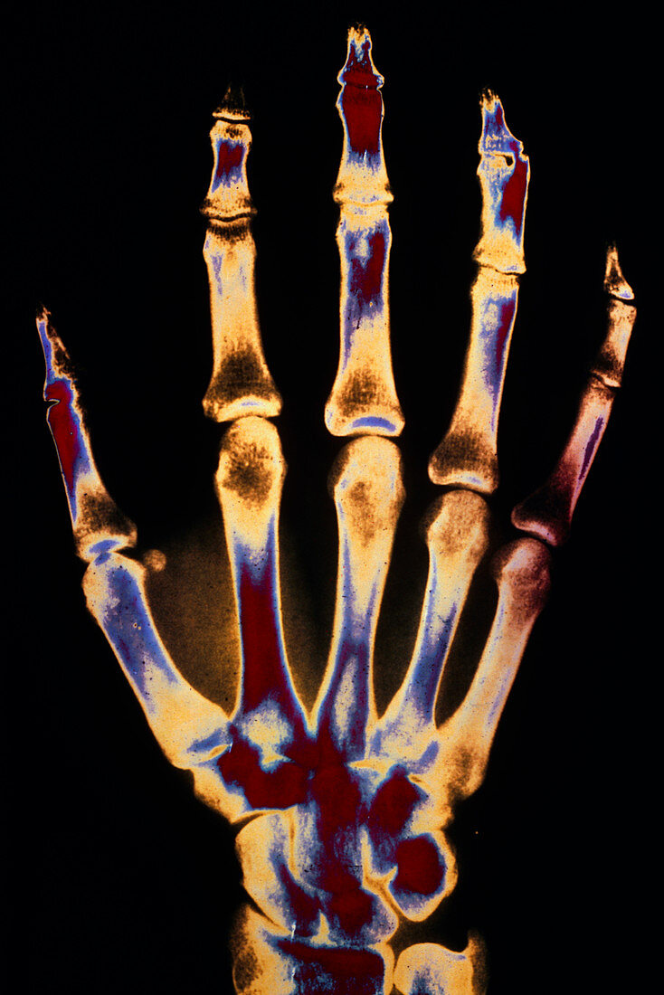 False-colour X-ray of a normal human right hand